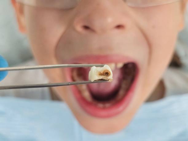 Best Emergency Treatment for Dental Infections or Abscesses in Front Royal, VA