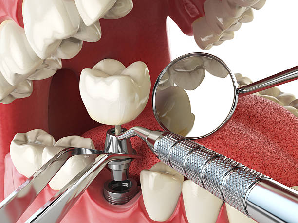 Best Emergency Wisdom Teeth Removal in Front Royal, VA